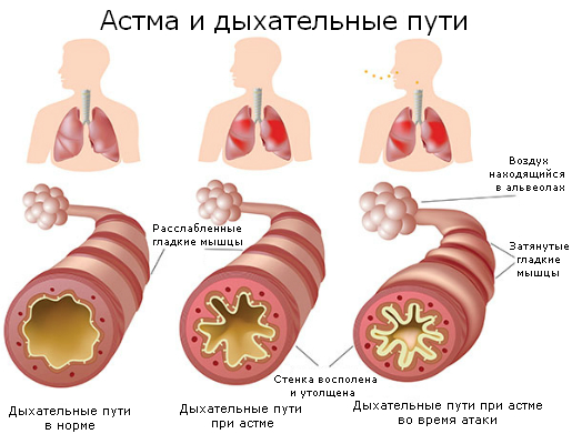 Лечение бронхиальной астмы в тюмени, аллерголог ПАРАРЦЕЛЬС